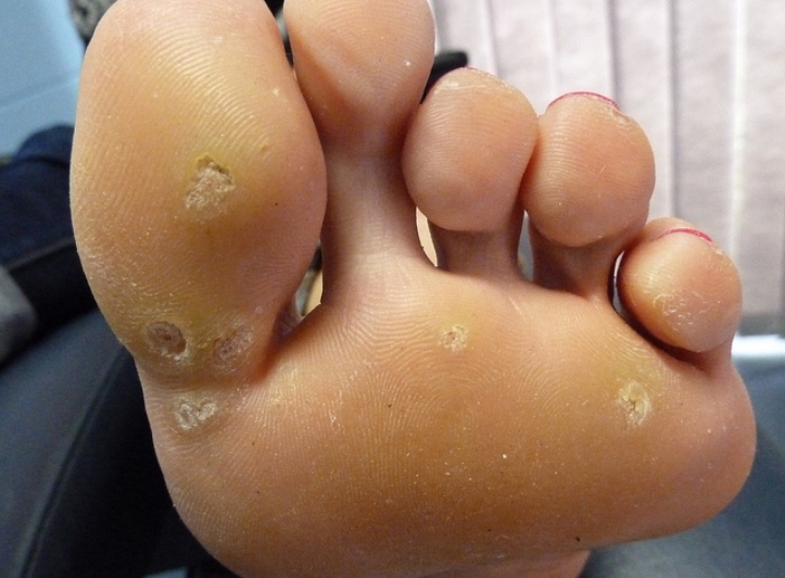 foot wart healing human papilloma virus hpv enfeksiyonu