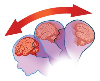 concussion-diagram_1.jpg